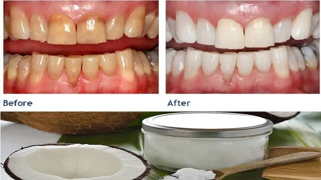 خواص روغن نارگیل برای سلامت دهان